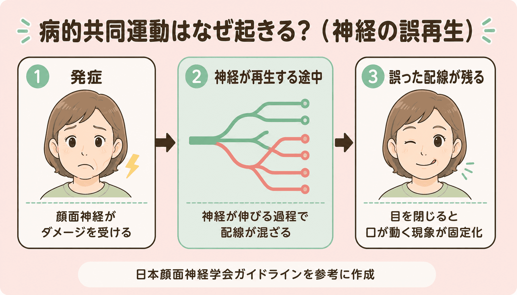 病的共同運動が起きる仕組み:神経の誤再生(日本顔面神経学会ガイドラインを参考に作成)